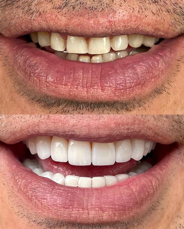 Antes y después de tratamiento de carillas